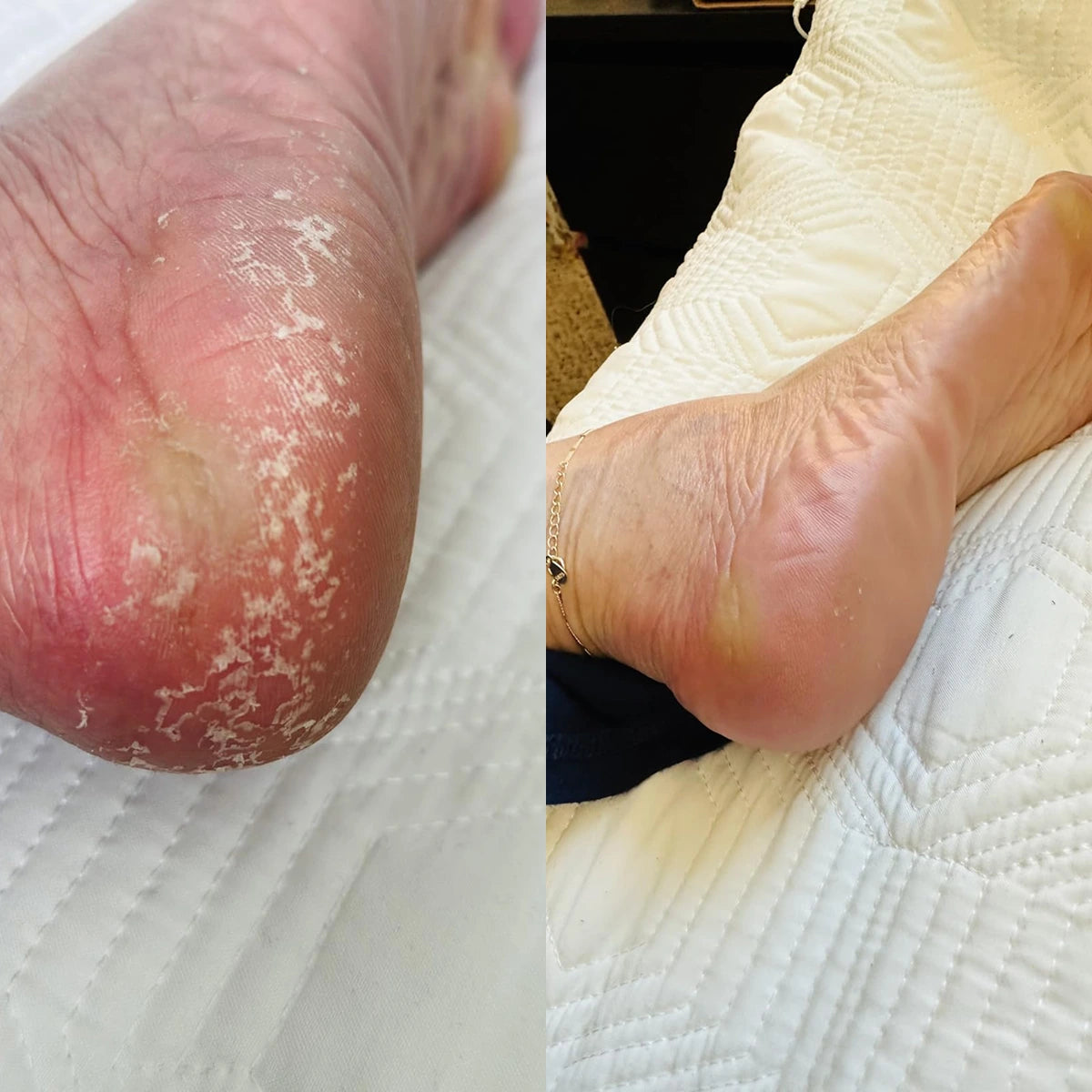 Urea Cream 40% for Cracked Heels & Callused Feet