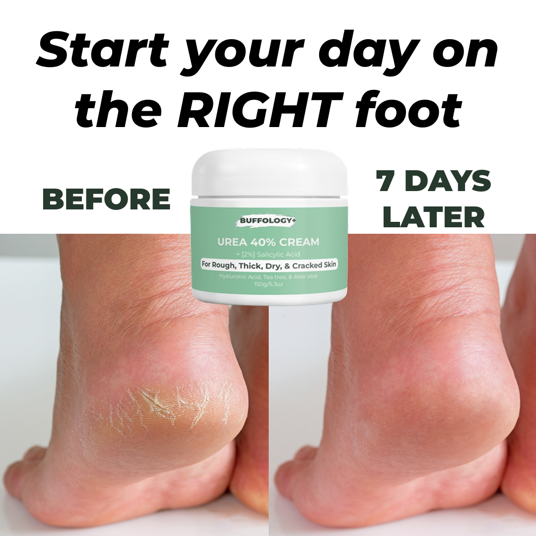 Urea Cream 40% for Cracked Heels & Callused Feet