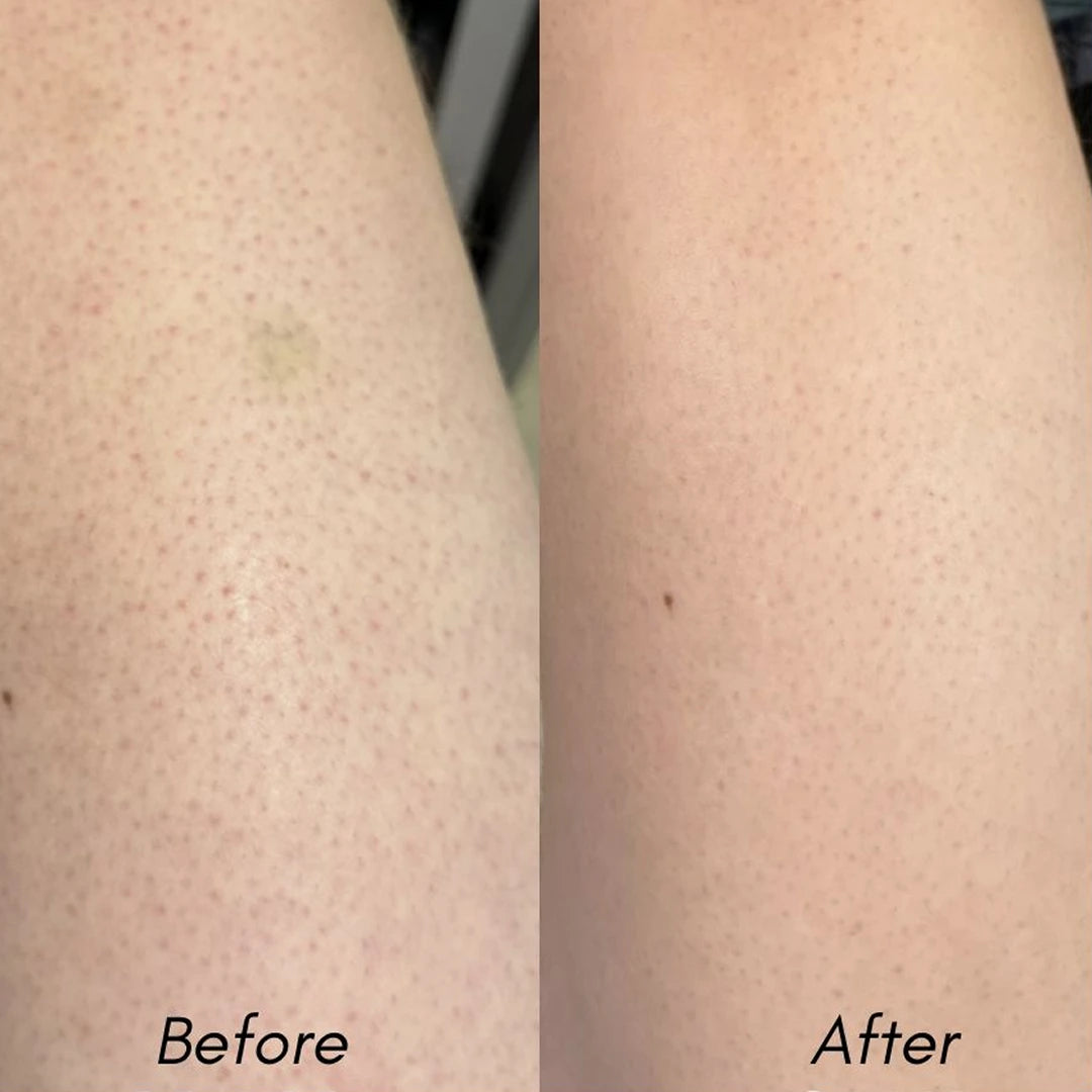 Urea Cream 40% for Keratosis Pilaris